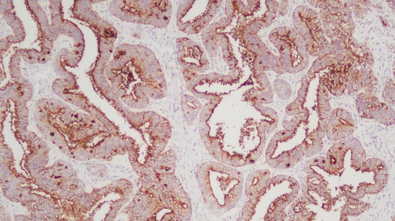 浆液性卵巢癌CA125(BP6014)染色