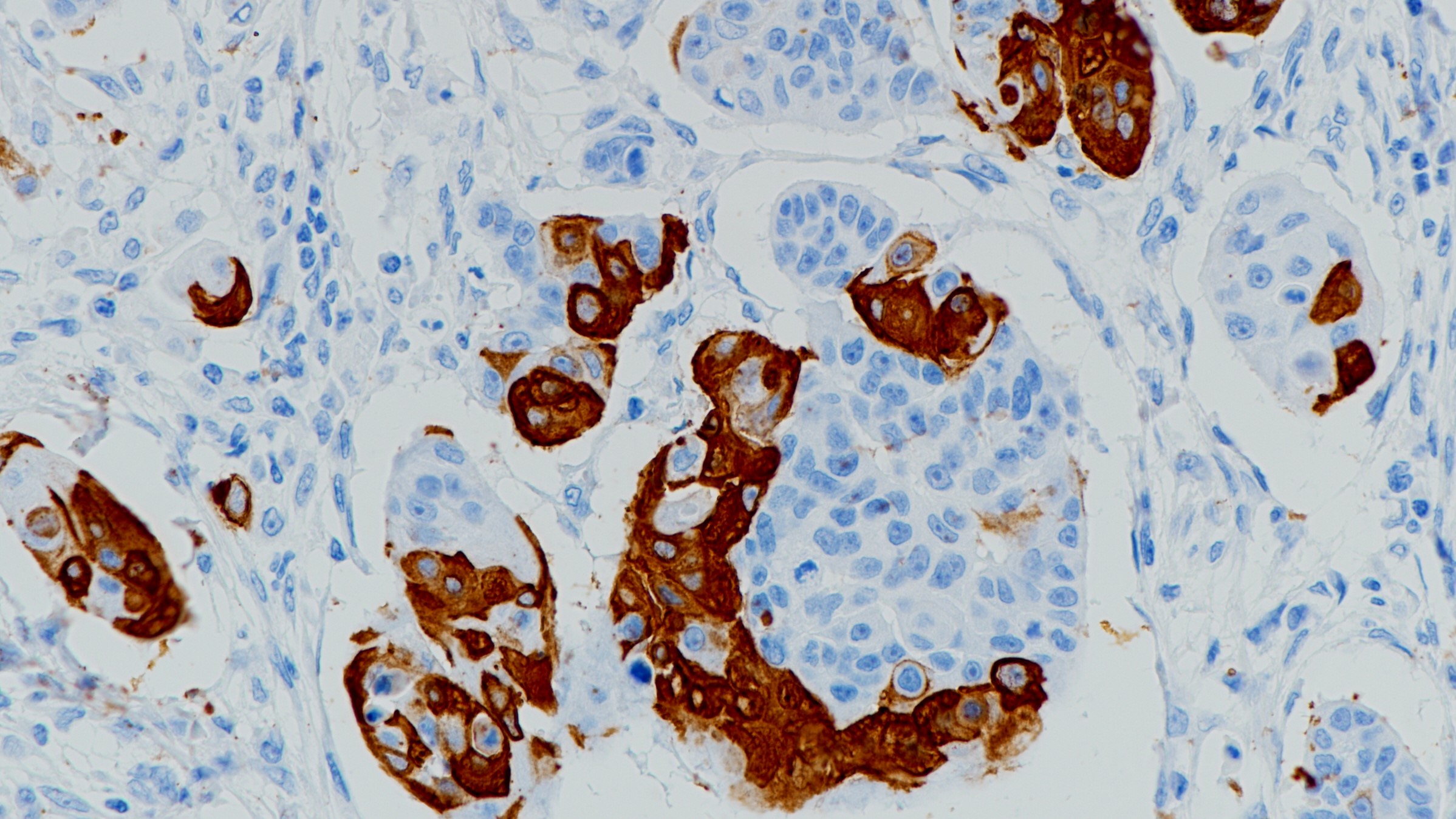 食管鳞癌CK10(BP6057)染色