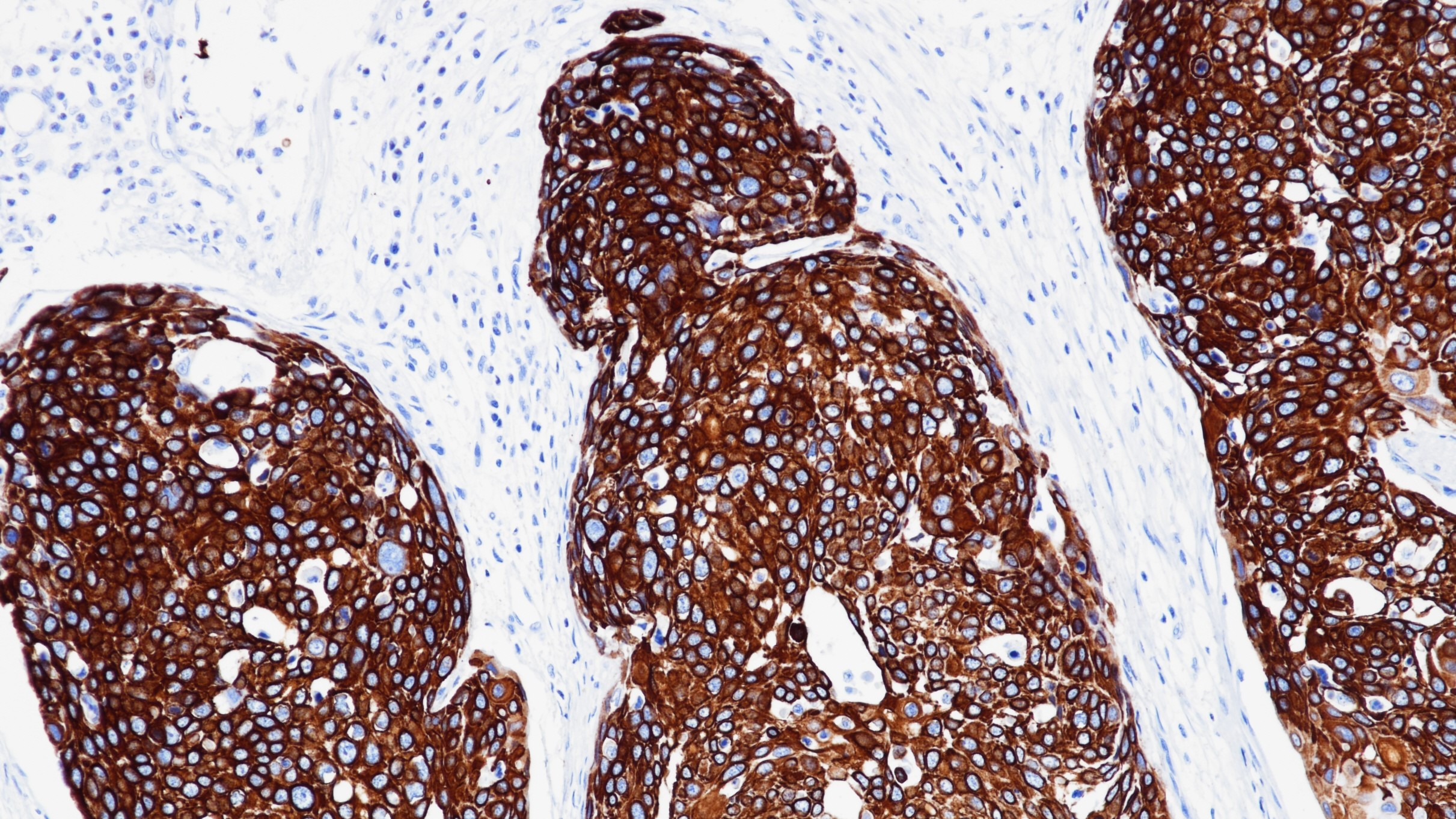 食管鳞癌CK14(BP6052)染色