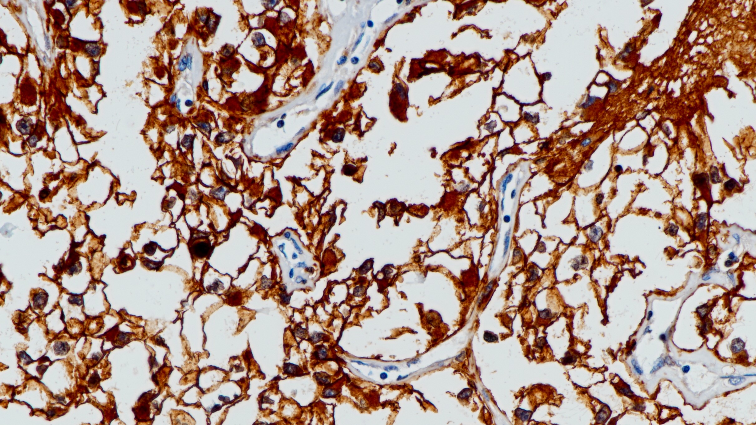 肾透明细胞癌CD10(BP6059)染色