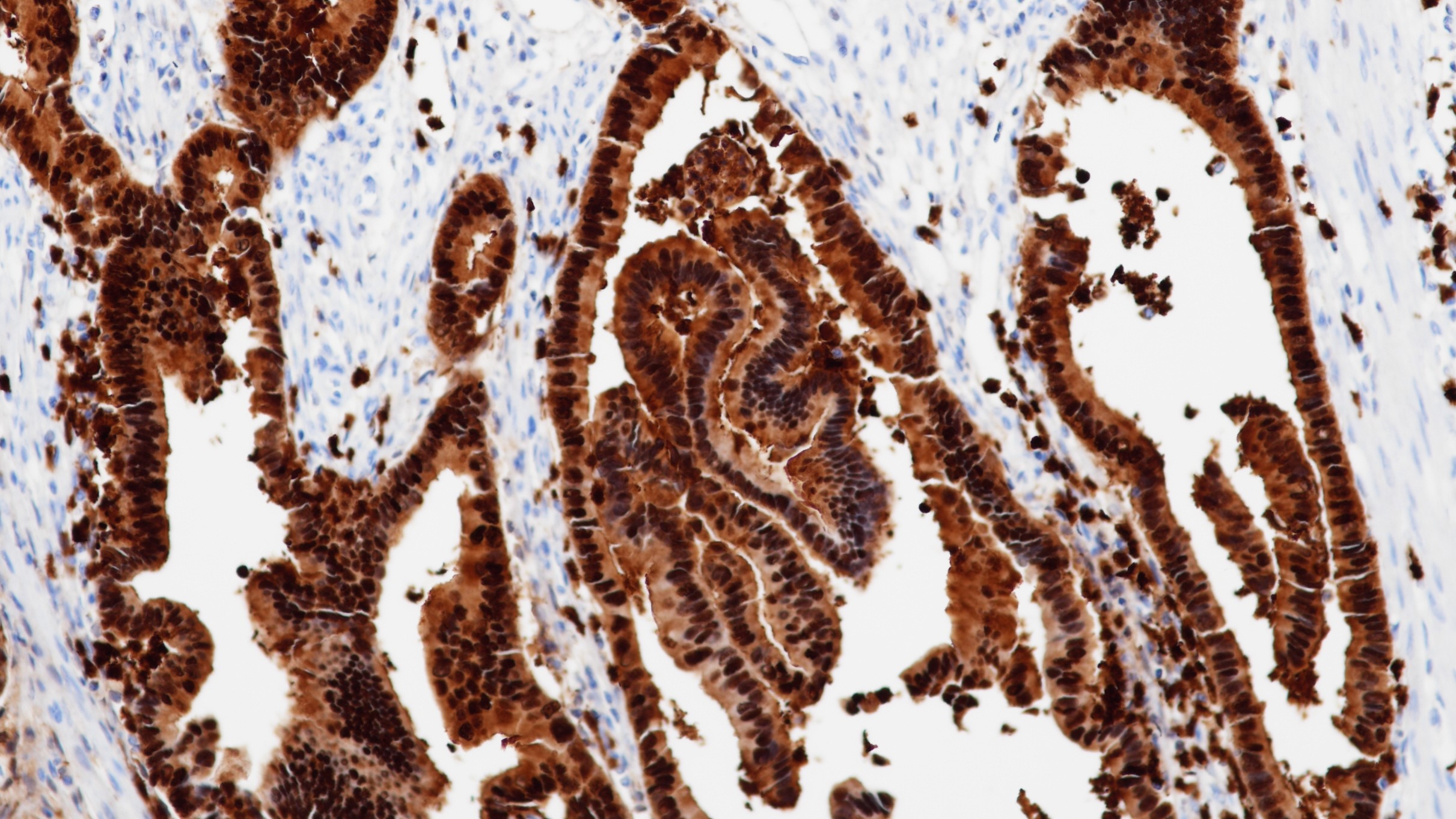胰腺导管癌S100P(BP6018)染色