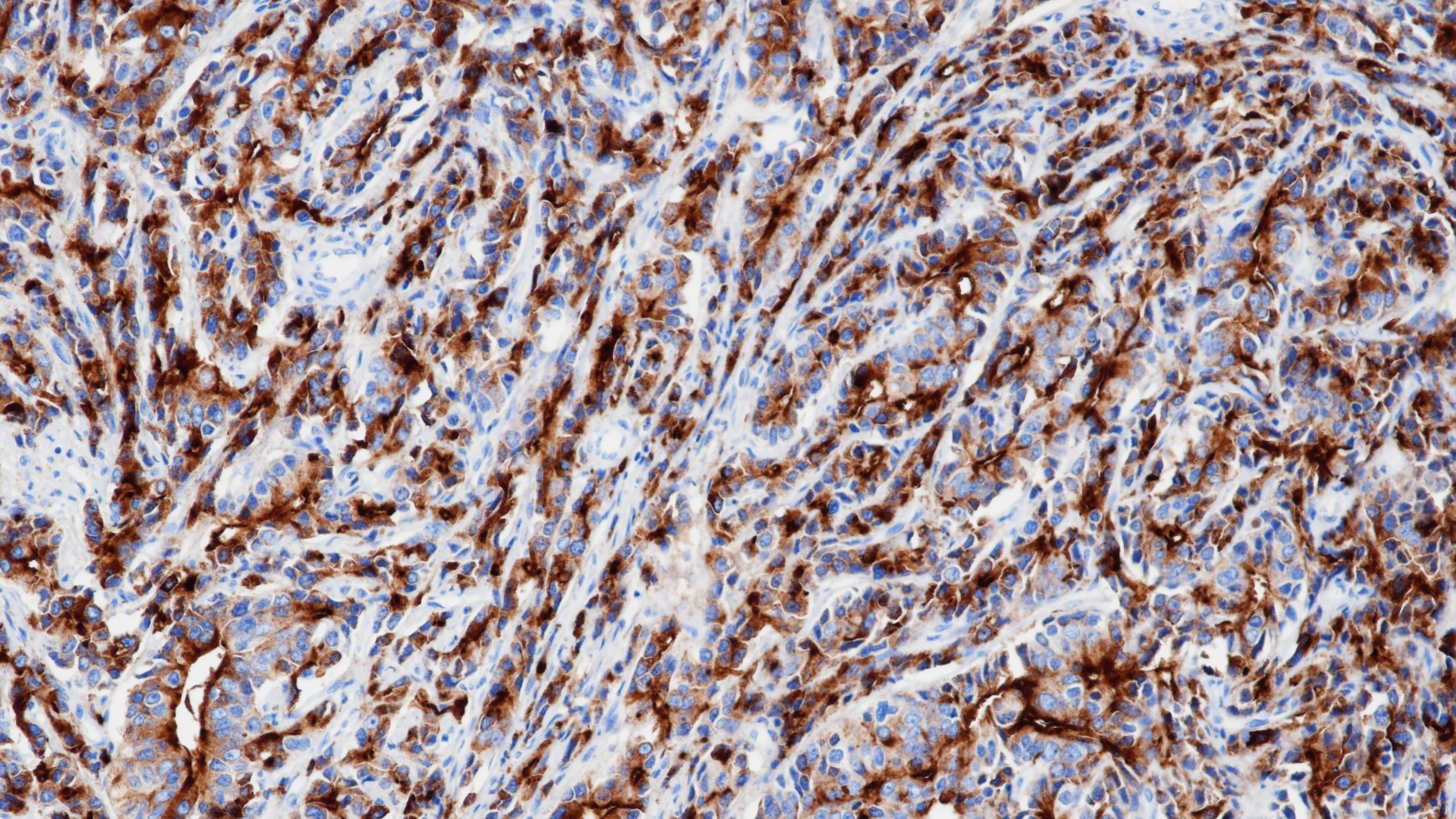 转移性前列腺癌PSA(BP6043)染色