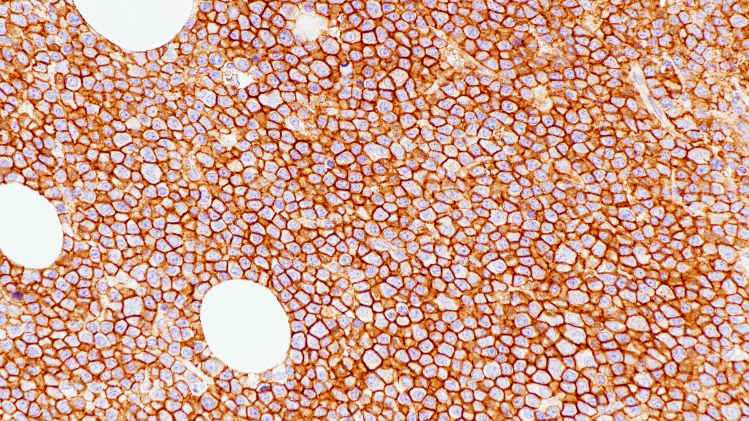浆细胞瘤CD138(BP6035)染色