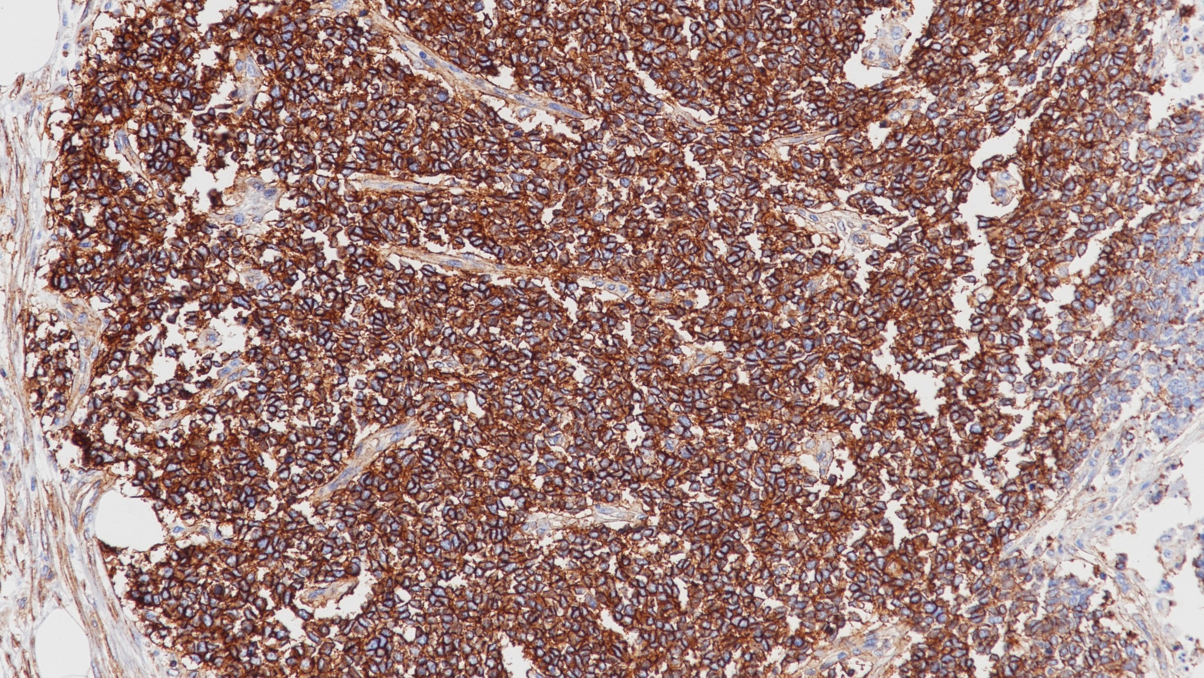 尤文氏肉瘤CD99(BP6013)染色