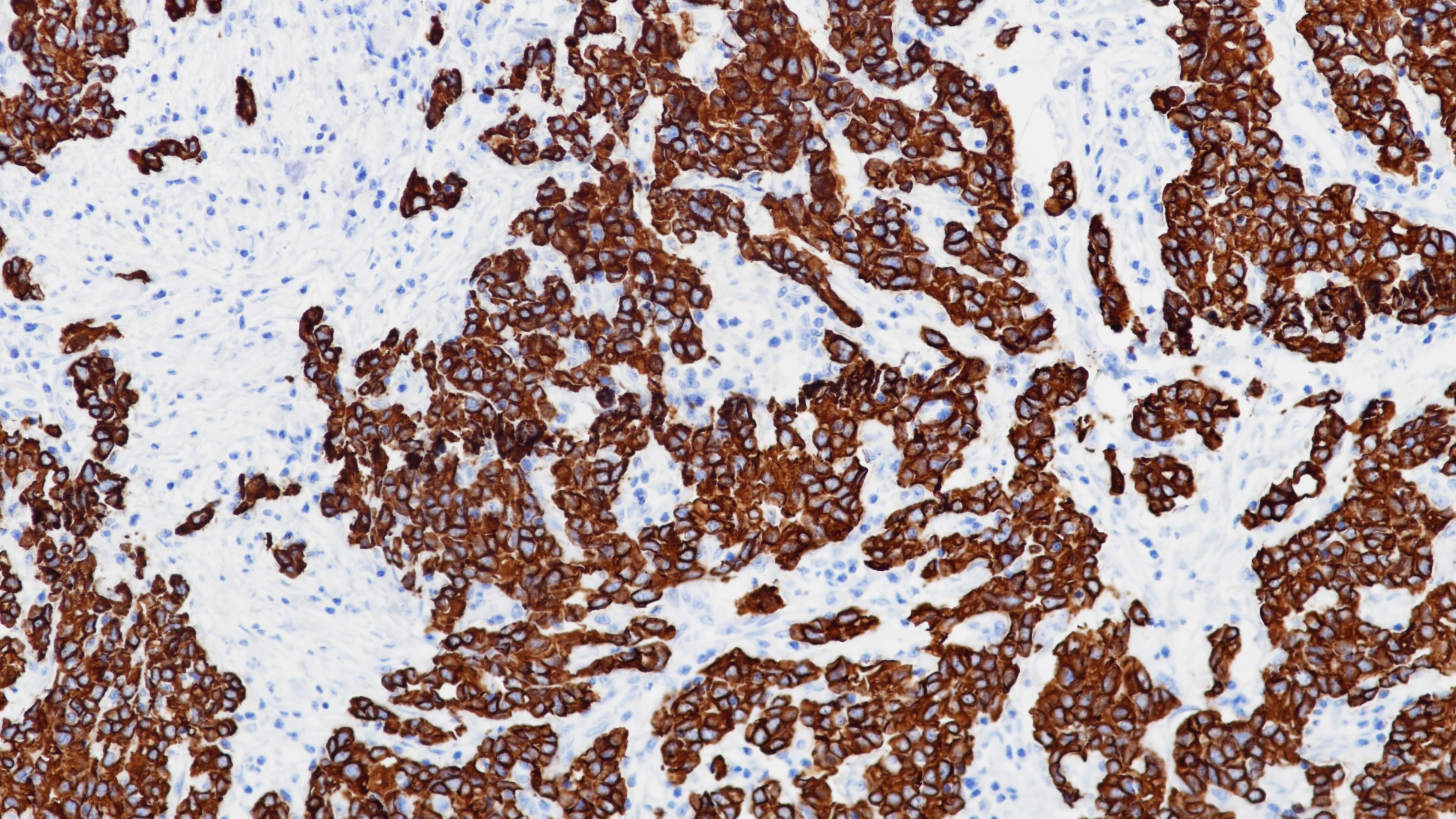 胃腺癌CK8(BP6005)染色