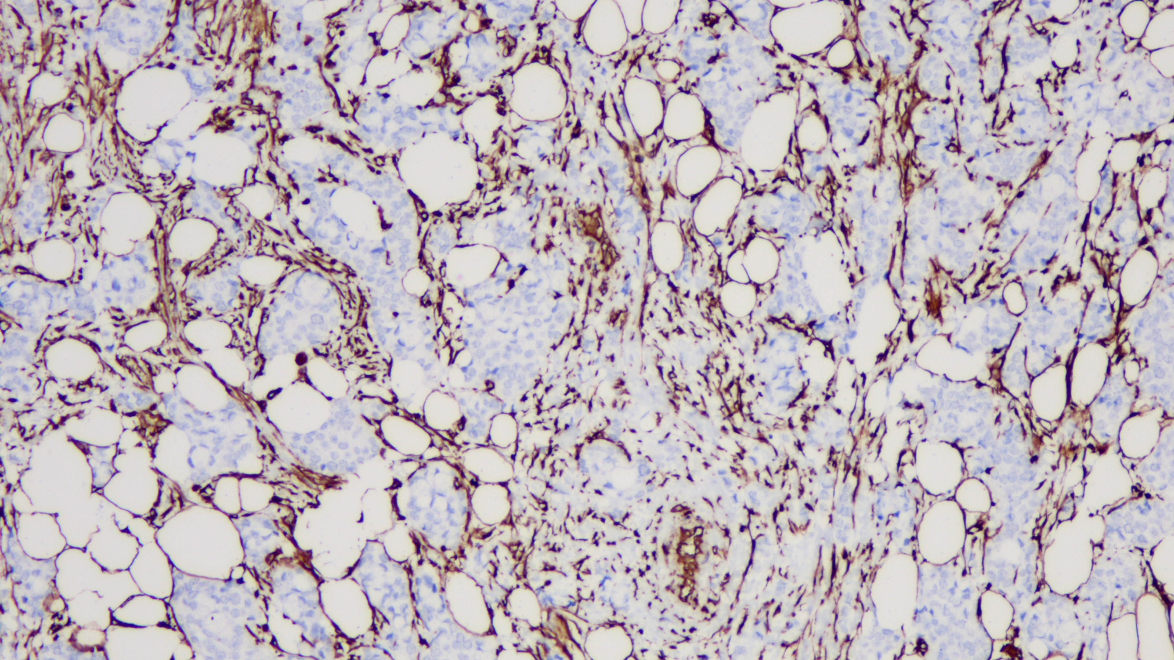 乳腺癌Vimentin(BP6010)染色