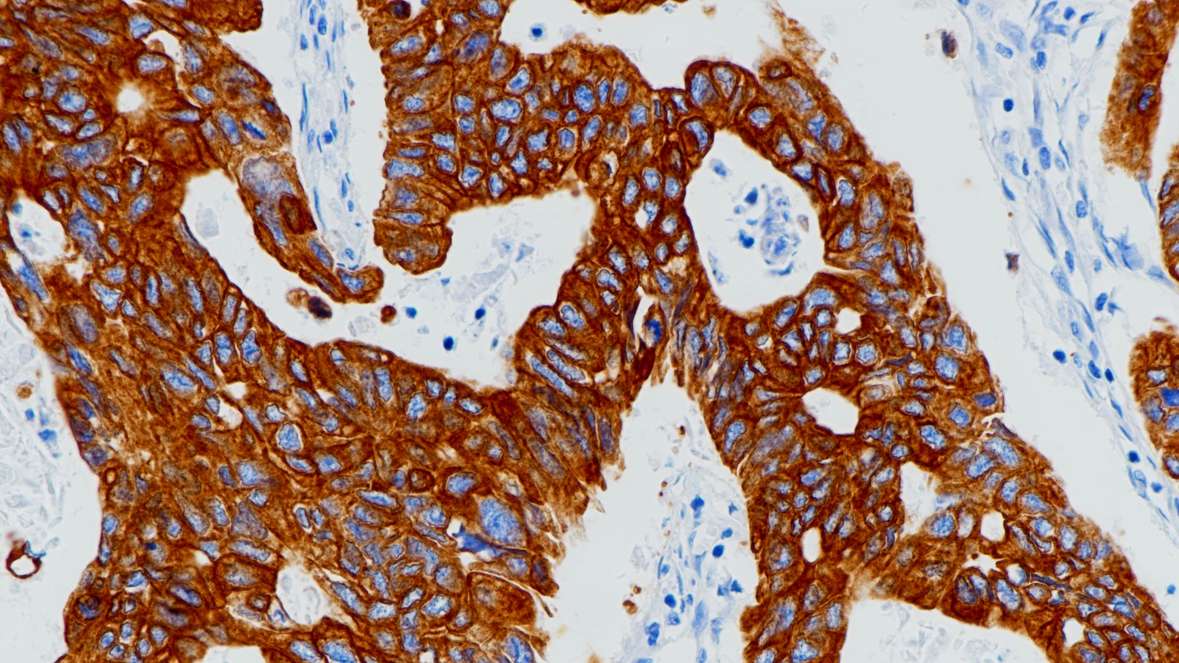 结肠癌CK19(BP6022)染色