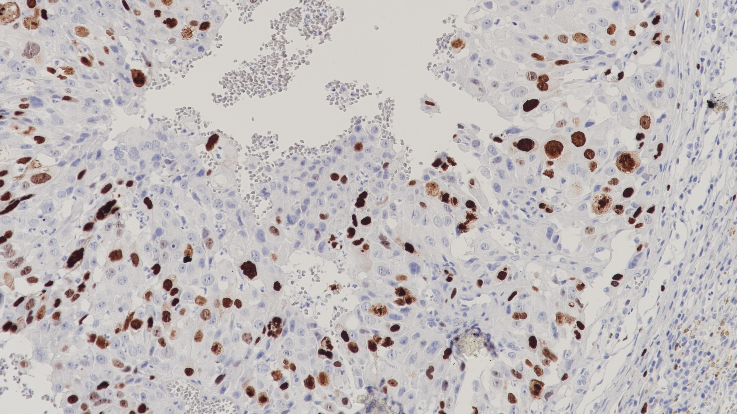 卵巢癌TOP2A(BP6016)染色