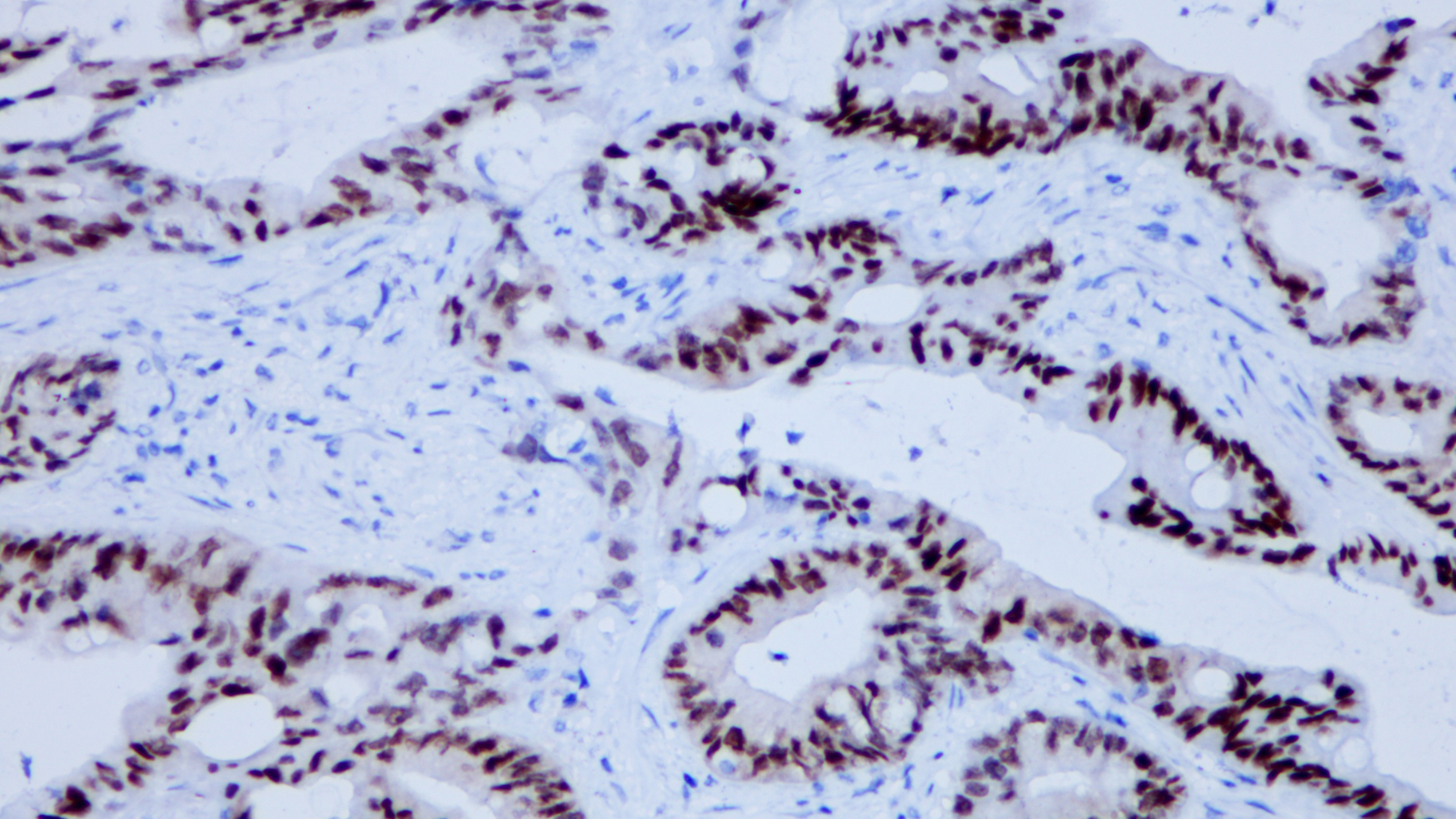 结肠腺癌CDX2(BP6023)染色