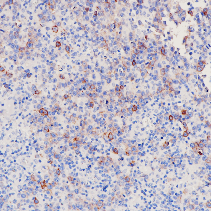 弥漫大B淋巴细胞瘤BCMA(BP6211)染色