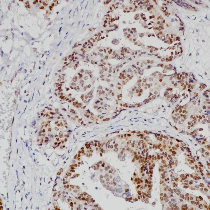 子宫内膜癌MGMT(BP6217)染色