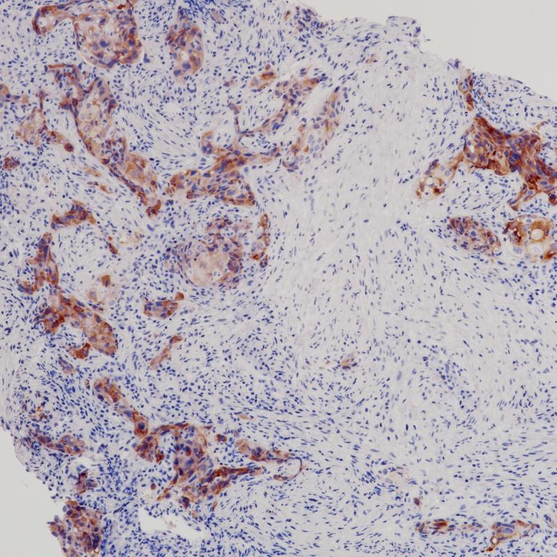 肺癌ROS1(BP6215)染色