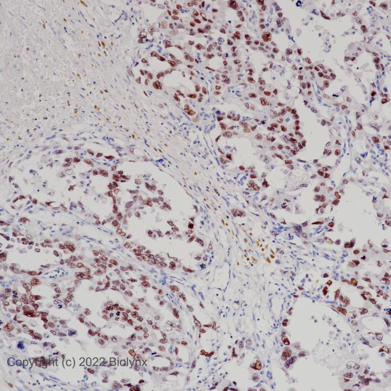 胚胎性癌SALL4(BP6204)染色