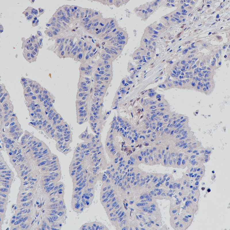 胰腺导管癌 肿瘤细胞缺失表达部位SMAD4(BP6219)染色