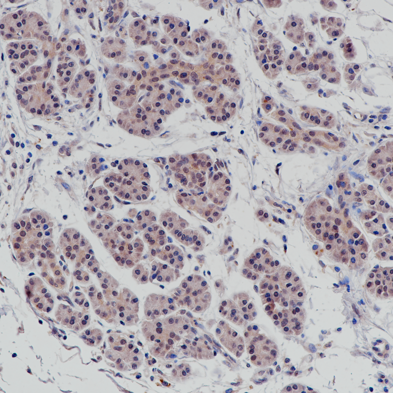 胰腺导管癌 正常表达部位SMAD4(BP6219)染色