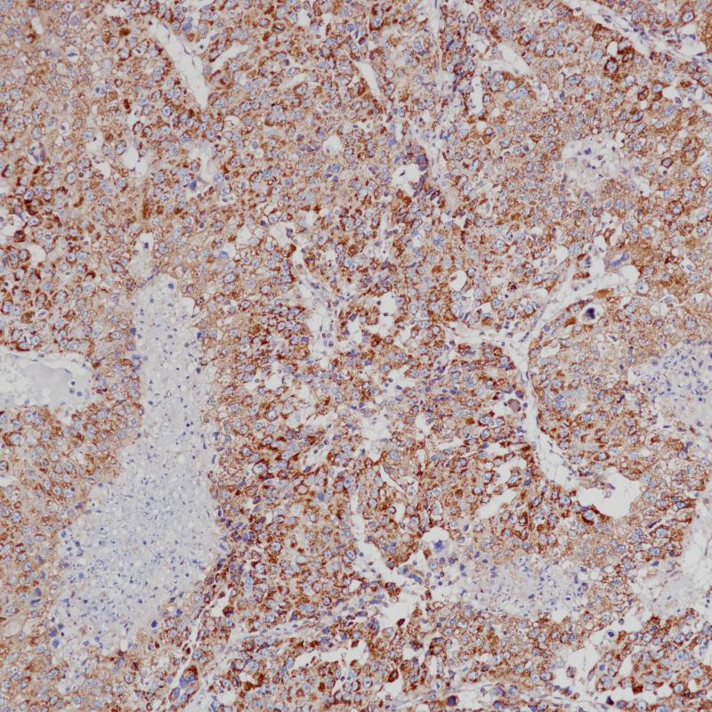 肝癌VEGF(BP6213)染色