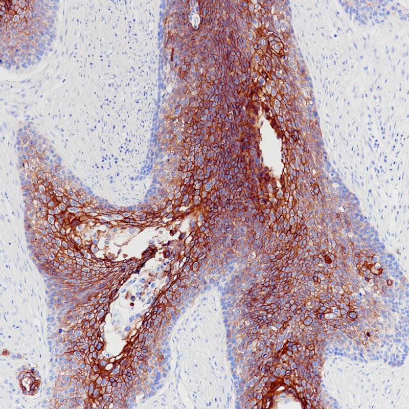 食管癌TROP-2(BP6208)染色