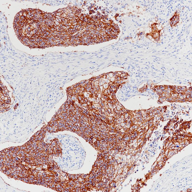 肺鳞癌TROP-2(BP6208)染色