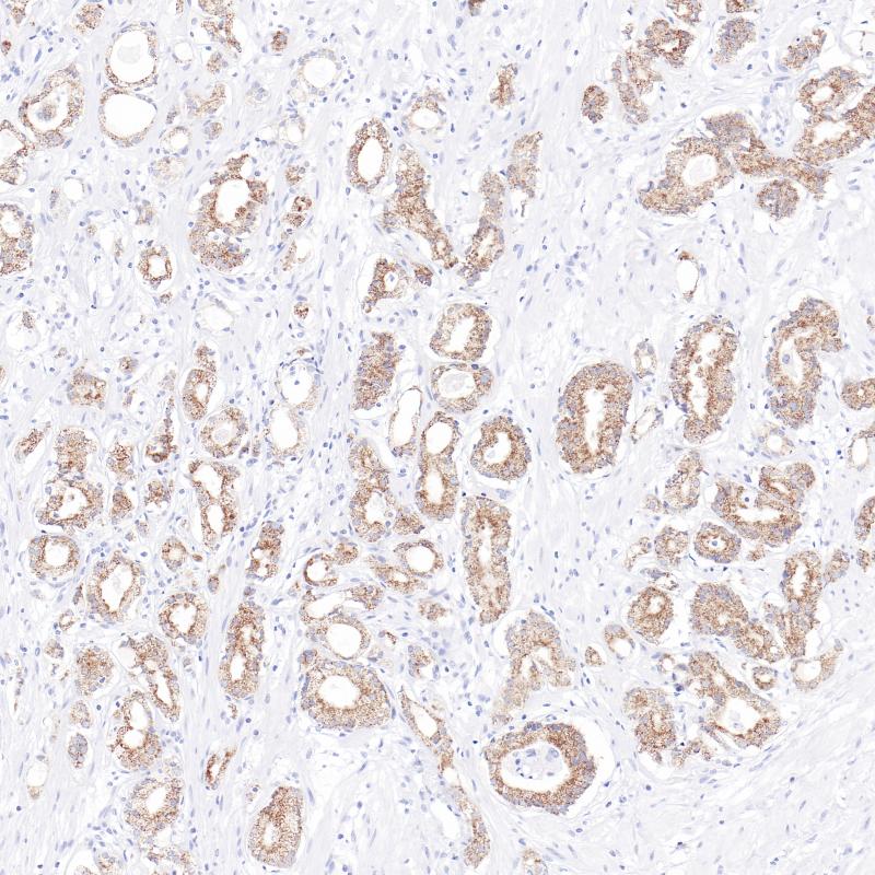 前列腺癌AMACR(BPM6227)染色