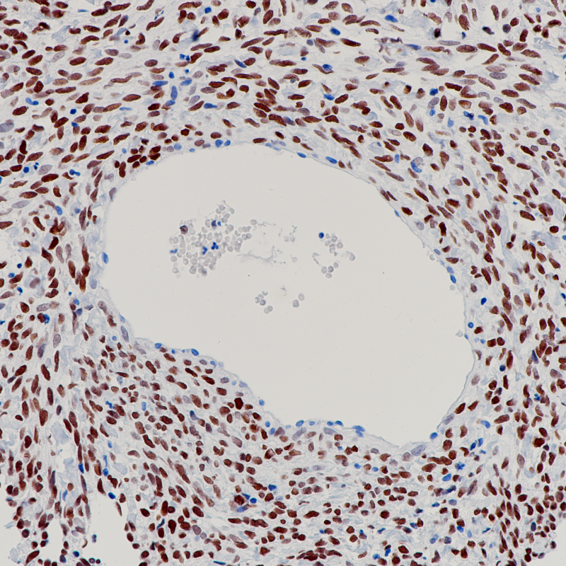 卵巢颗粒细胞瘤FOXL2(BP6235)染色