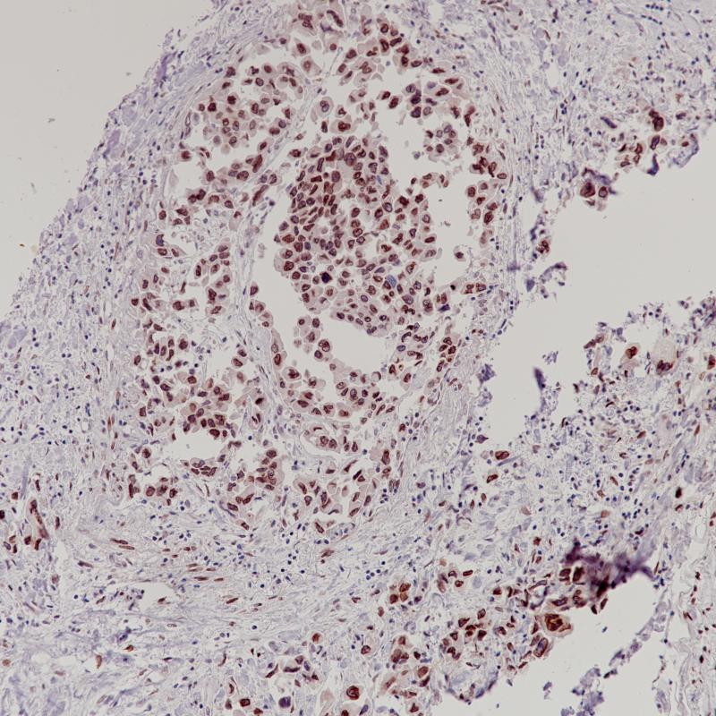 肺腺癌CDK4(BP6230)染色