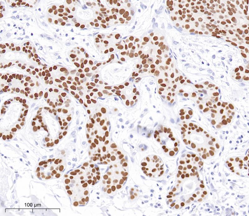 乳腺导管癌GATA-3(BP6229)染色
