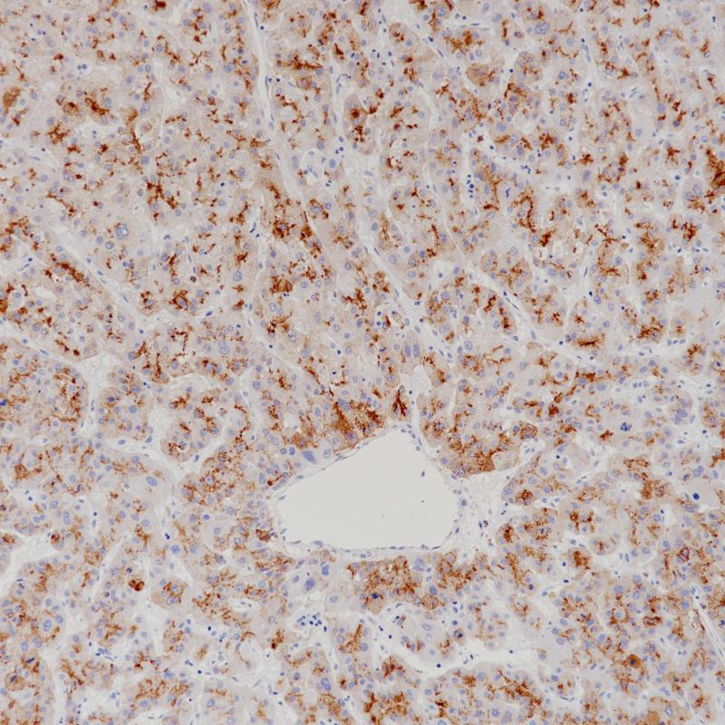 肝癌Glypcian-3(BP6228)染色-2