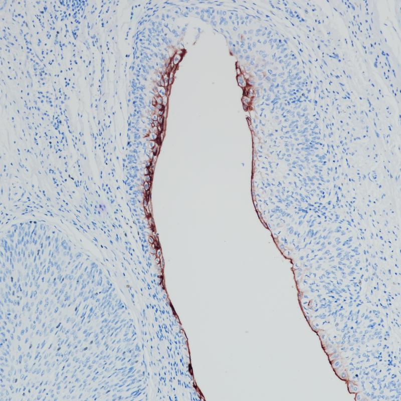 尿路上皮癌Uroplakin III(BP6199)染色