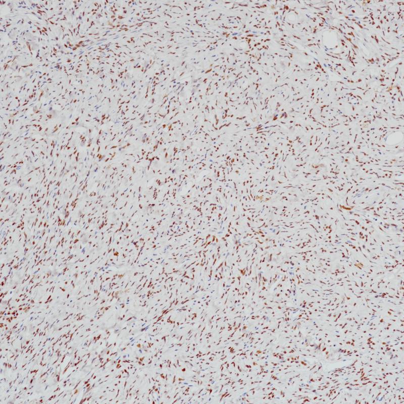孤立性纤维瘤STAT6(BP6193)染色