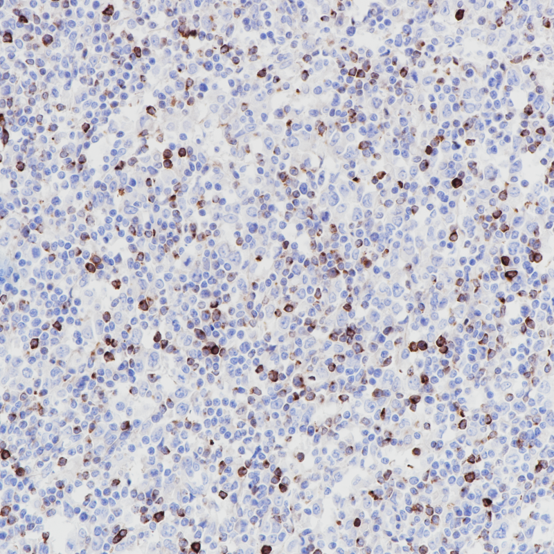 淋巴瘤LAG-3(BP6192)染色