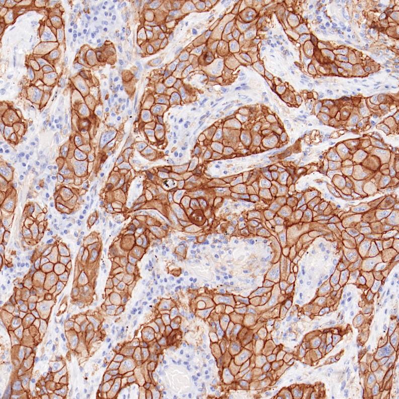 非小细胞肺癌 PD-L1（BP6099）染色