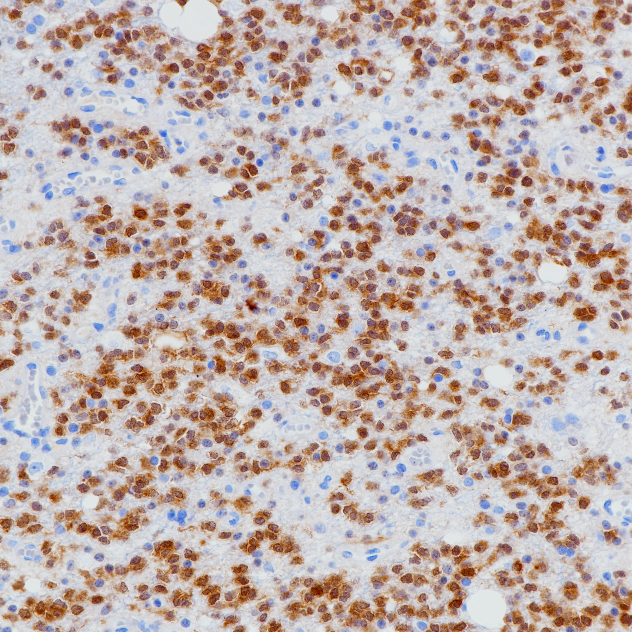星形胶质细胞瘤IDH-1（BP6205）染色