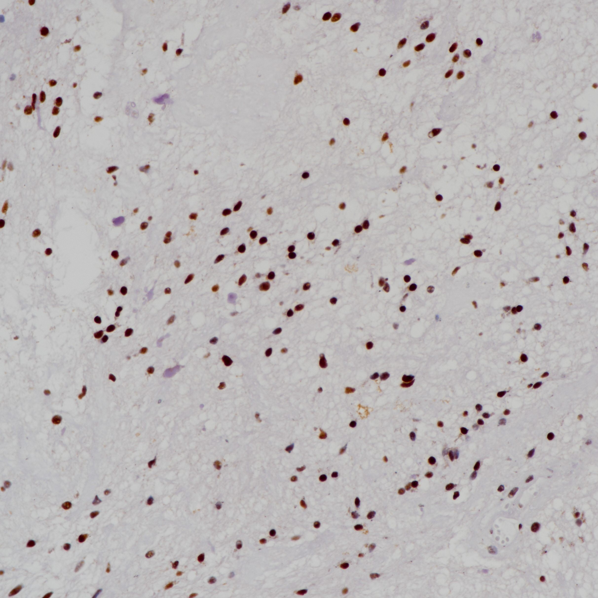 毛细胞性胶质瘤ATRX（BP6202）染色