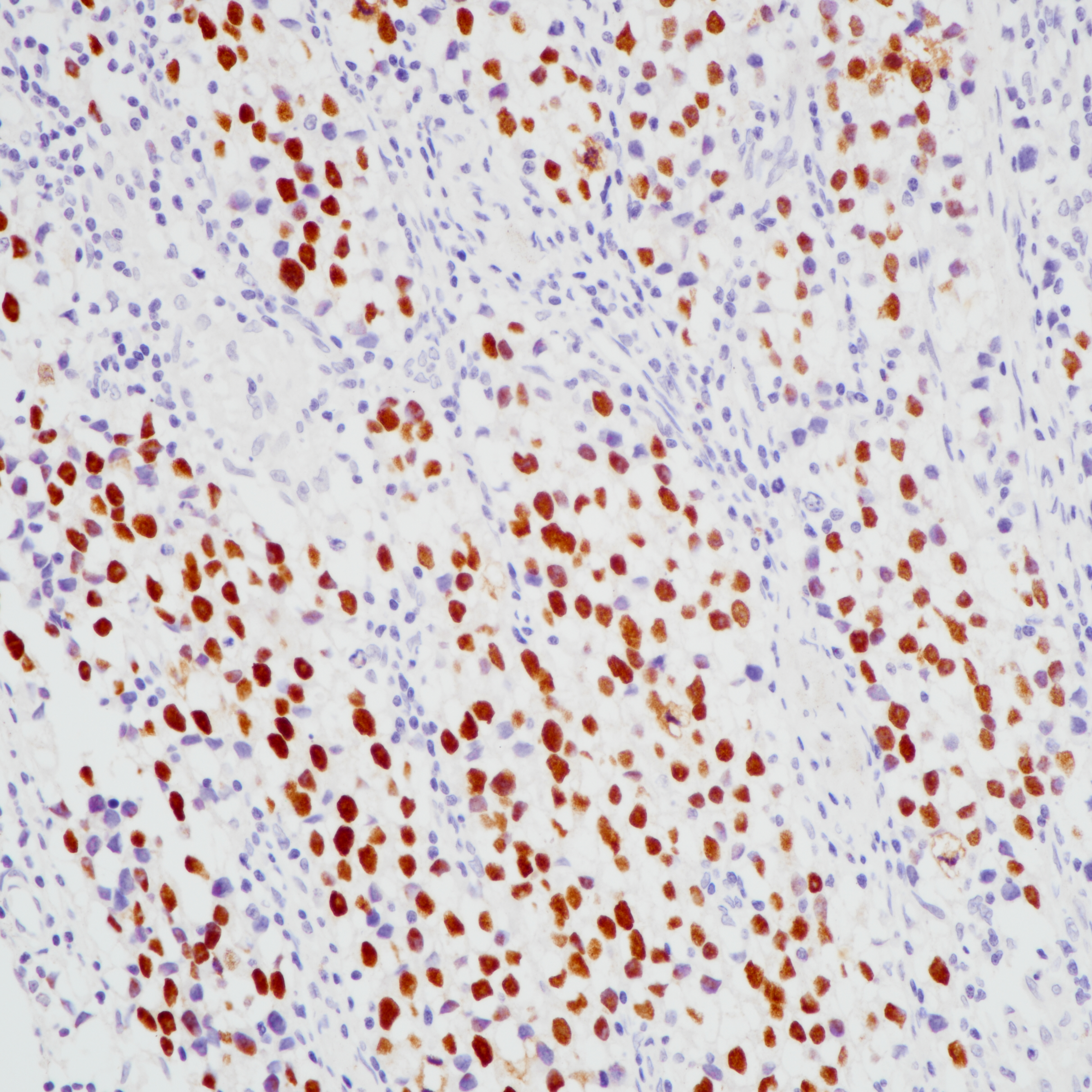 精原细胞瘤SALL4（BP6245）染色