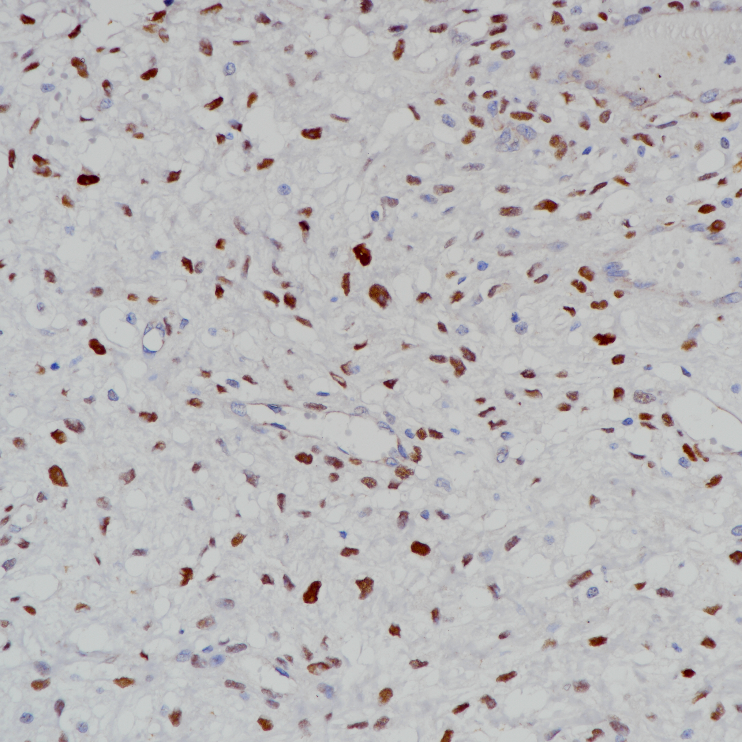 脂肪肉瘤MDM2（BP6203）染色