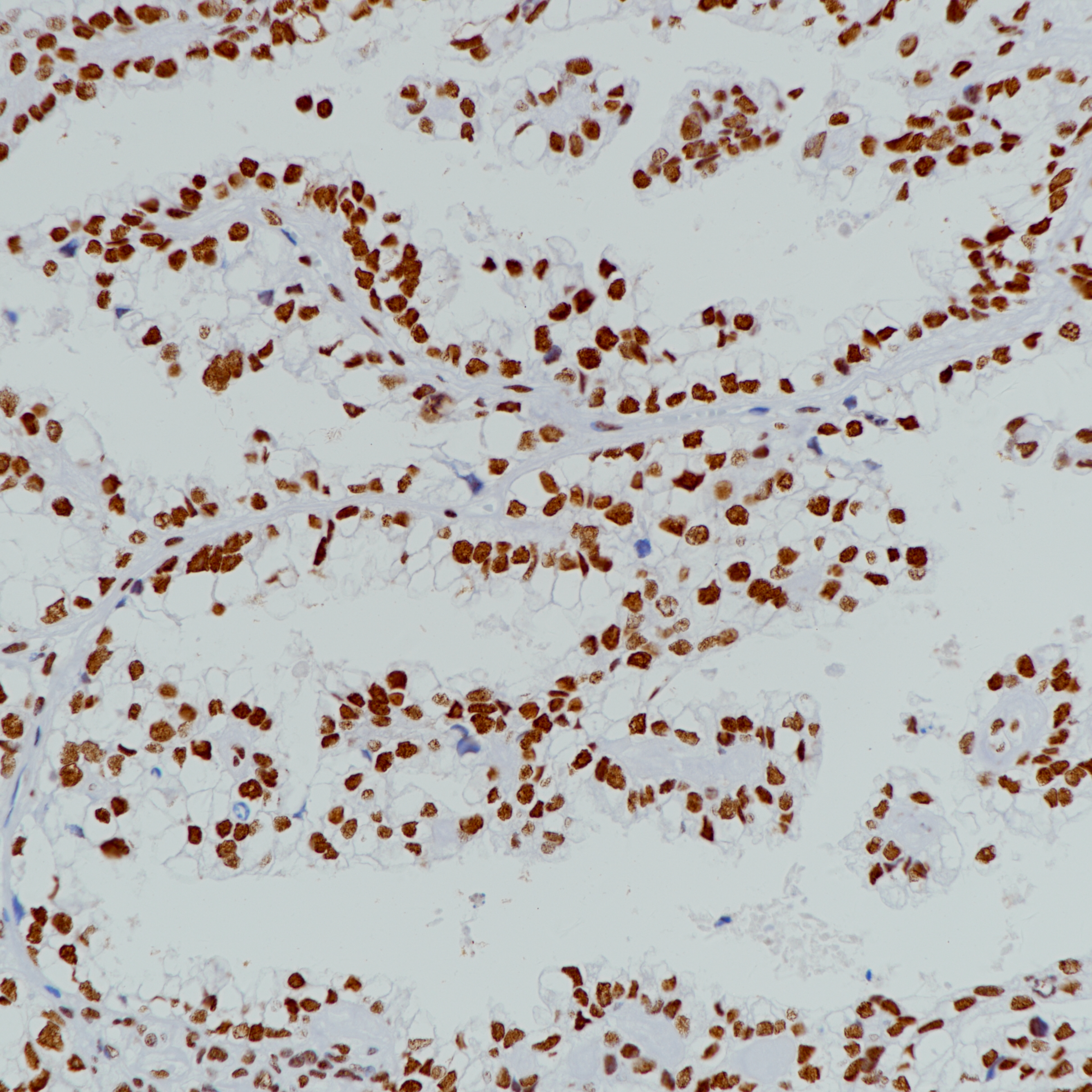 卵巢透明细胞癌BRG1（BP6201）染色