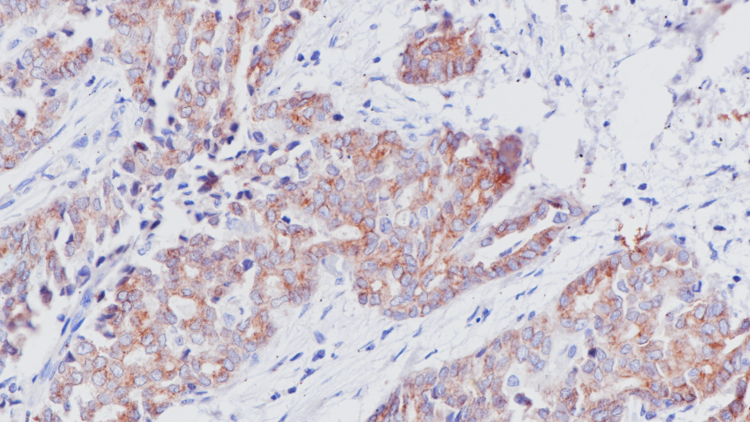 非小细胞肺癌ALK(BP6165)染色