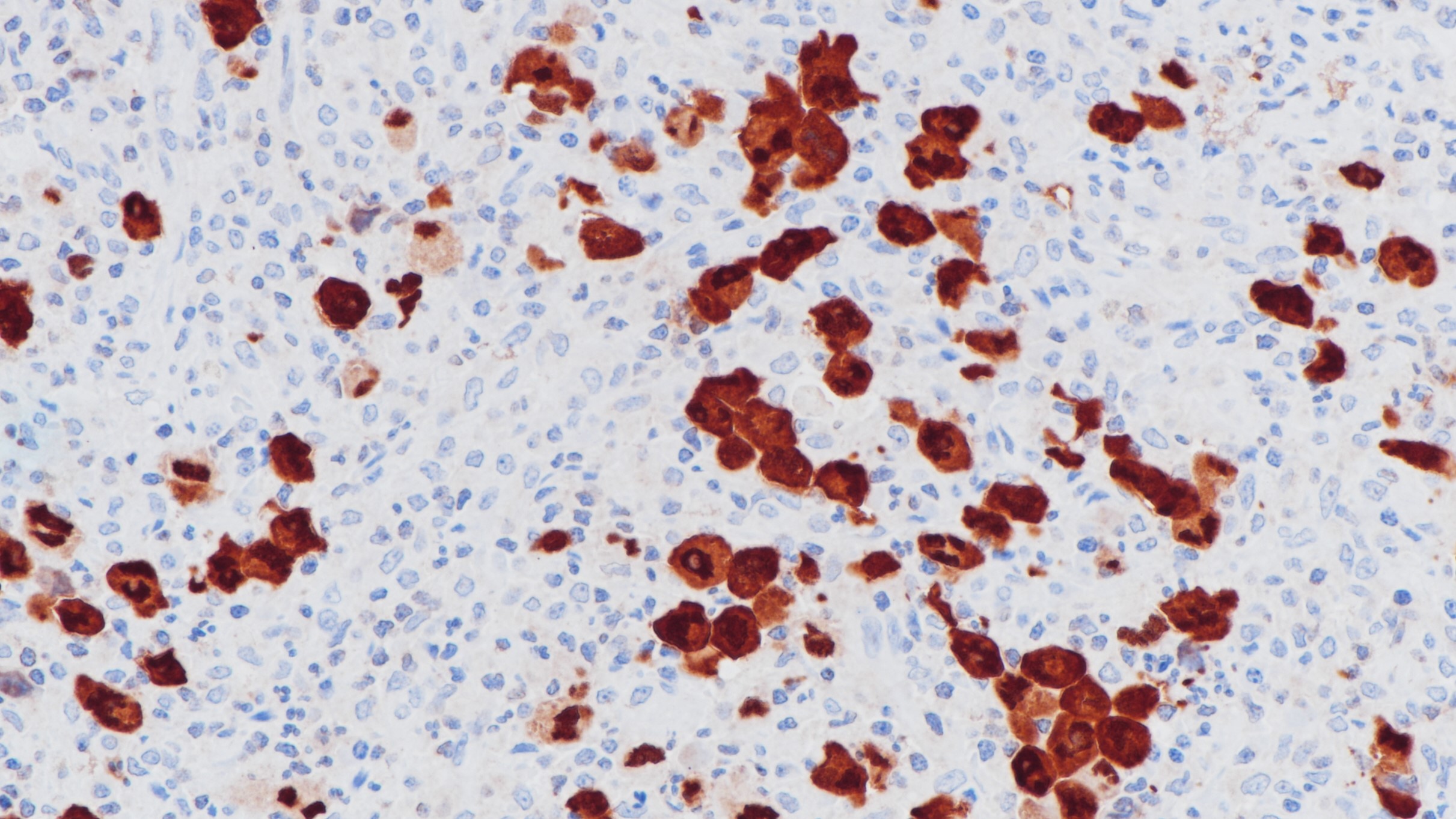 间变性大细胞淋巴瘤ALK(BP6165)染色