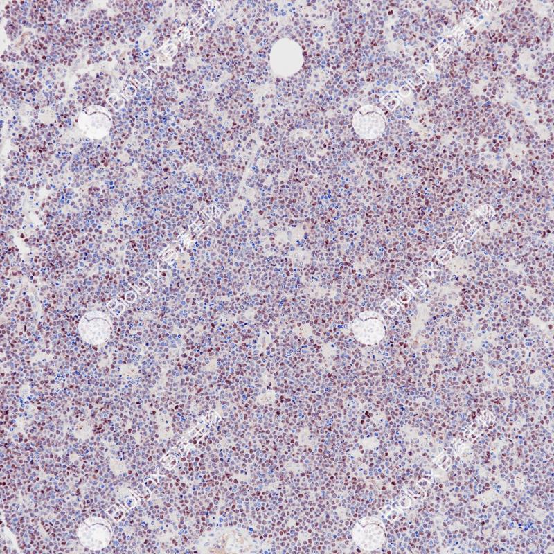 伯基特淋巴瘤c-Myc（BP6258）染色