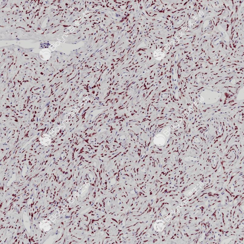 孤立性纤维瘤STAT6（BP6246）染色