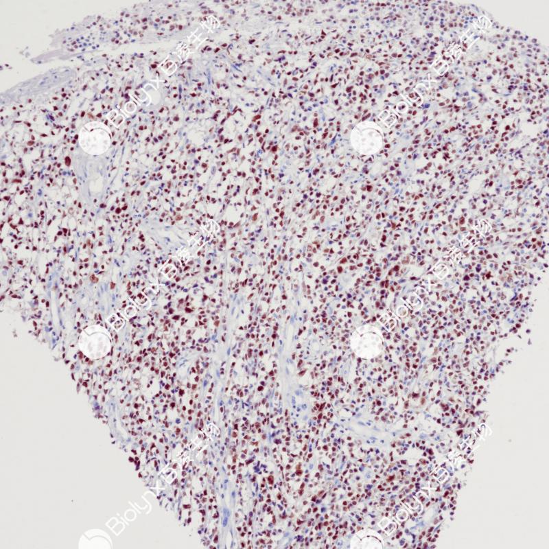 弥漫大B细胞淋巴瘤MUM1（BP6251）染色
