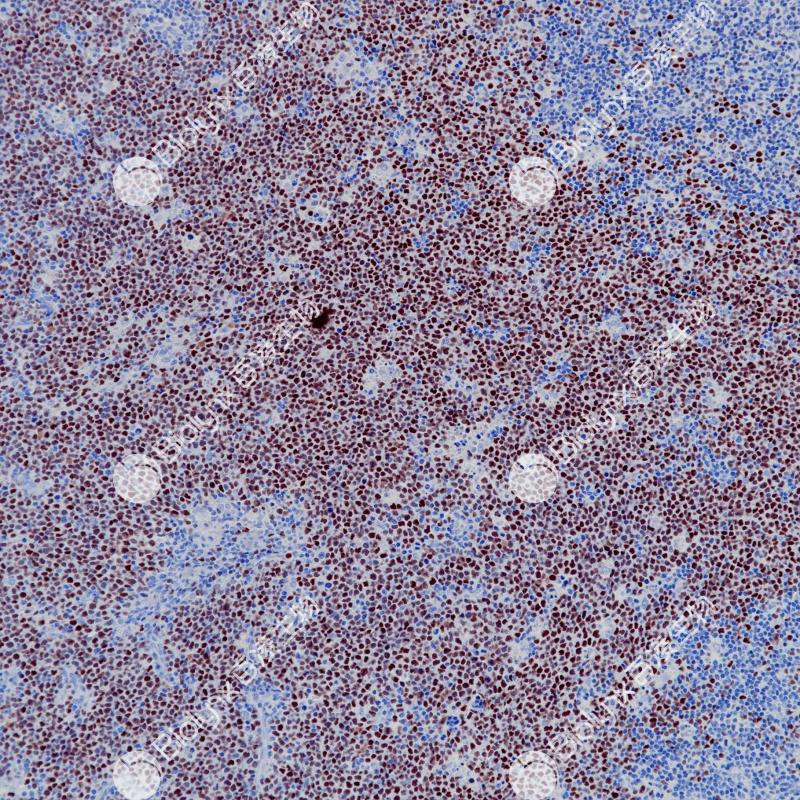 弥漫大B细胞淋巴瘤Bcl-6（BP6261）染色