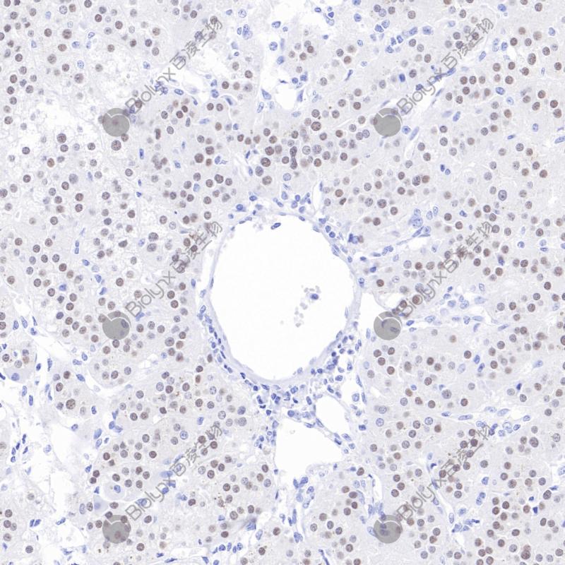 肾上腺皮质腺瘤SF-1（BP6236）染色