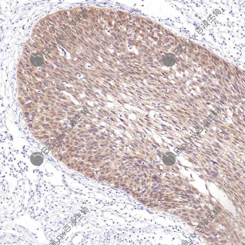 宫颈上皮内瘤变p16（BPM6238）染色