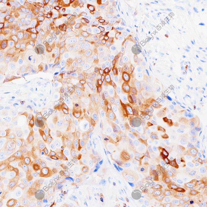 乳腺癌Stathmin（BP6241）染色