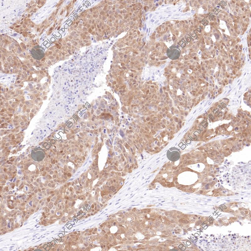 子宫内膜癌p16（BPM6238）染色