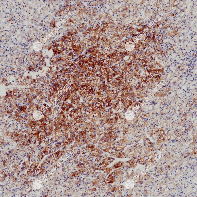 肾透明细胞癌（HLA-G）染色