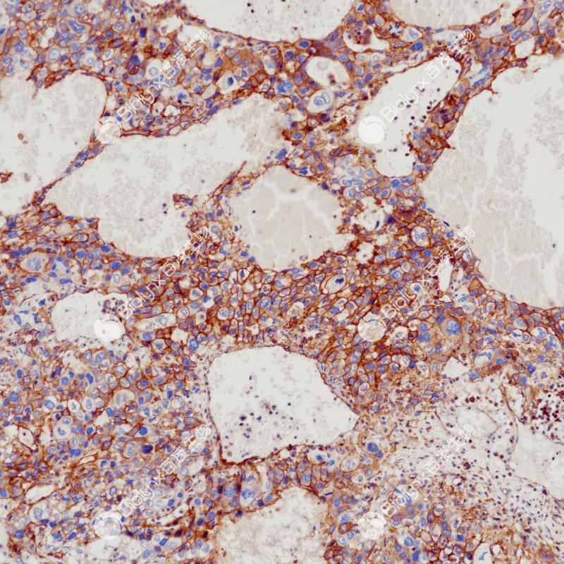 绒毛膜癌（HLA-G）染色