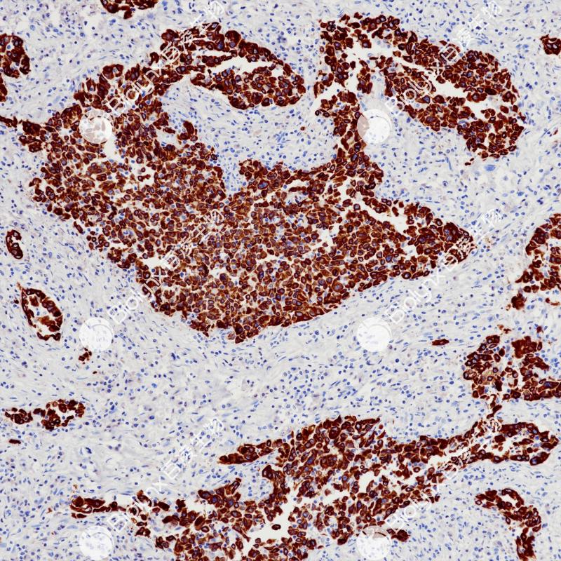 宫颈癌CK5&6（BP6252）染色