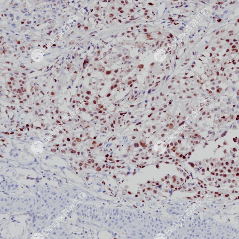 恶性黑色素瘤PRAME（BP6248）染色